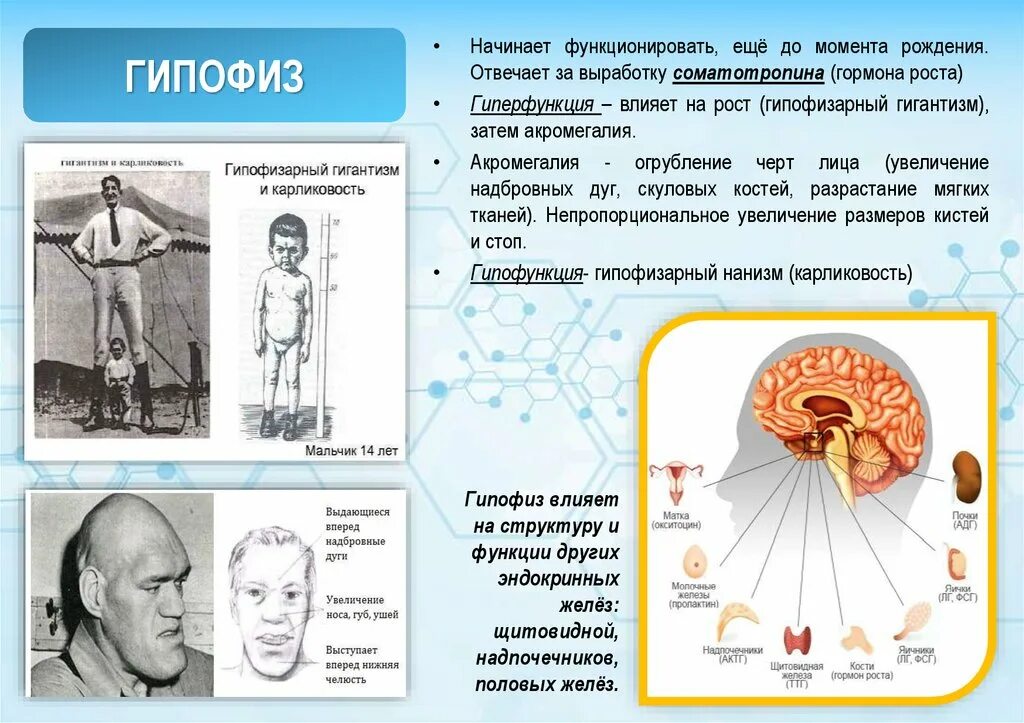 Гипофиз связан. Гипофиза гиперфункция соматотропин. Нарушение работы желез внутренней секреции. Болезни гипофиза заболевания эндокринной системы. Эндокринная система соматотропин гипофиз.