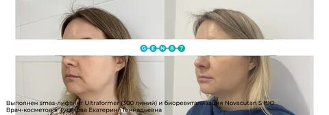 Смас биоревитализация