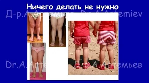 Ноги х в 2 года