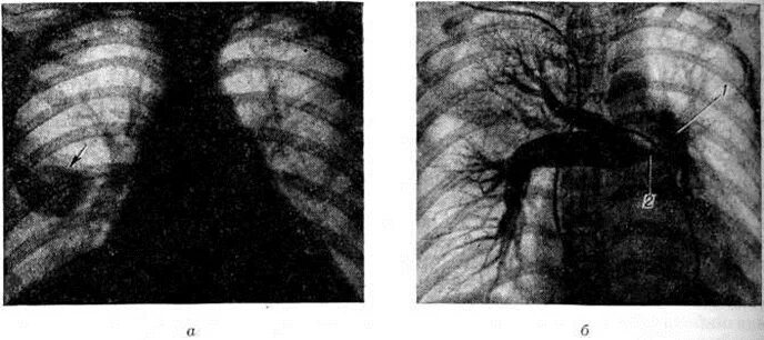 Тромбофлебит легких. Тромбоз легочной артерии 126.9 что такое. Тромбоэмболия легочной артерии рентген. Эмболия легочной артерии рентген.