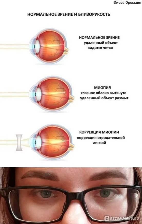 Лазерная коррекция зрения миопия -3. Осложнения лазерной коррекции зрения ласик. Лазерная корректировка зрения. Операция на близорукость лазером.