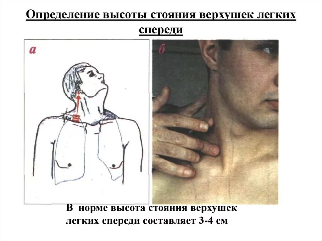 Верхушки легких в норме. Определение высоты стояния верхушек легких. Вычотастоянияверхушек легких. Определение высоты стояния верхушек легких спереди.