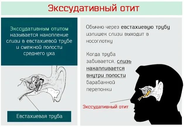 Можно ли лечить отит. Экссудативный средний отит: клиника, диагностика. Экссудат в среднем ухе. Симптомы экссудативного среднего отита. Экссудативный отит среднего уха.