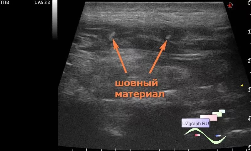 Узи абсцесса мягких тканей протокол. Узи картина фибросаркома. Smas лифтинг аппарат альтера. Узи мягких тканей филлеры. Липома мягких тканей на узи.