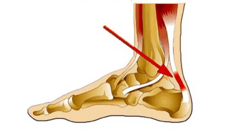 Тендинит большеберцовой мышцы. Сухожилия берцовой кости воспаление. Тендинит задней большеберцовой мышцы голени. Разрыв сухожилия задней большеберцовой мышцы. Прилипшая пятка характерна