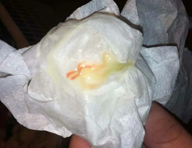 Слизь после свечки. Выделения при беременности. Слизисто гнойные выделения. Желто молочные выделения. Выделения с кровяными прожилками.