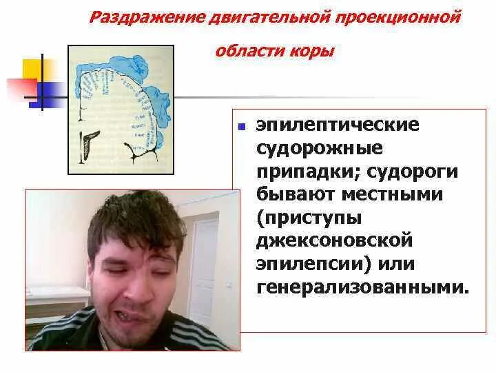 Фокальный судорожный припадок. Фокальные (парциальные) формы эпилепсии. Фокальной эпилептической. Фокальные эпилептические синдромы. Фокальный моторный припадок.