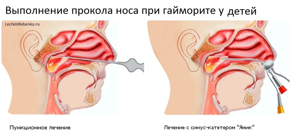 Сколько лечат гайморит. Синус катетер ЯМИК сфеноидит. Двухсторонний гайморит.