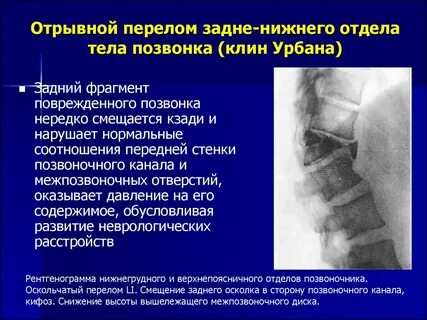 Закрытый компрессионный перелом