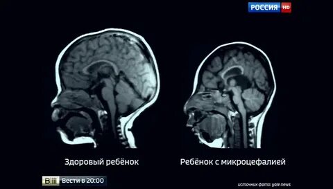 Симптомы микроцефалии у детей