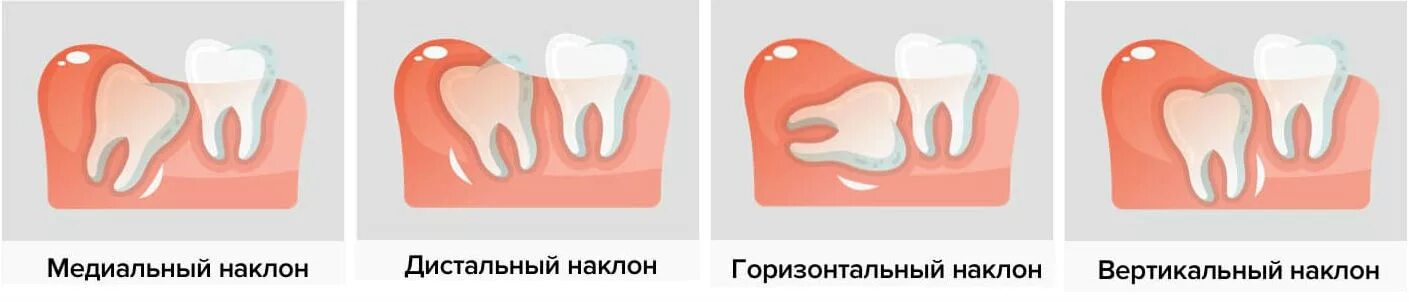 Симптомы неправильного прорезывания зуба мудрости. Перикоронит клиническая картина. Режется зуб мудрости симптомы. Перикоронарит симптомы. Как долго растут зубы мудрости