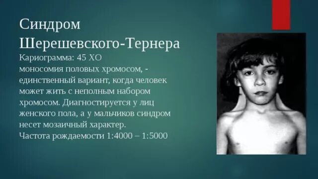 Синдром тернера мкб 10. Синдром шерешевского тернера мозаичный вариант. шерешевского -тернера дисгенезия гонад. синдром шерешевского-тернера (моносомия х).. кариограмма шерешевского тернера.