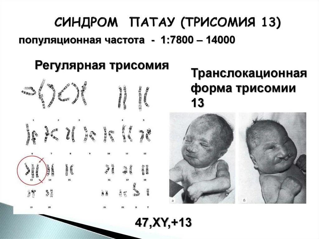 Синдром дауна генотип и фенотип. Синдром патау трисомия по 13 хромосоме кариотип. триплоидия, синдром патау. наследственная болезнь синдром патау. хромосомные аномалии (синдром патау, трисомия 13.