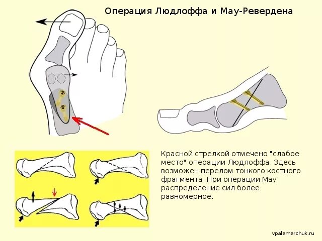 Халюс вальгус операция с винтами. Операция шеде-брандеса при вальгусной деформации. Схемы операций халюкс вальгус. Деформация стопы hallux valgus. Вальгусная операция отзывы