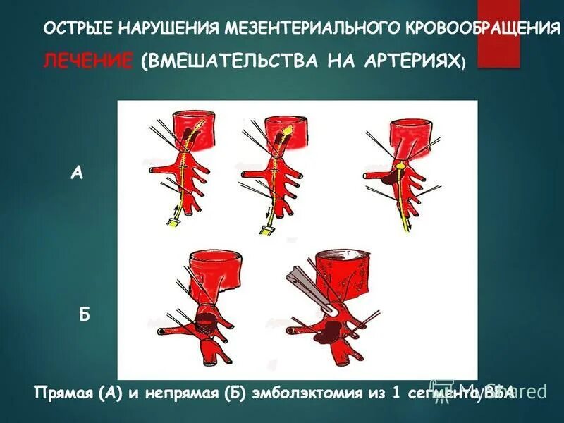 Острые нарушения системы кровообращения. Острое нарушение мезентериального кровообращения. эмболэктомия верхней брыжеечной артерии.
