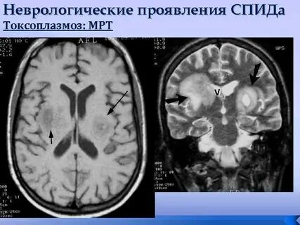 Вич мозга