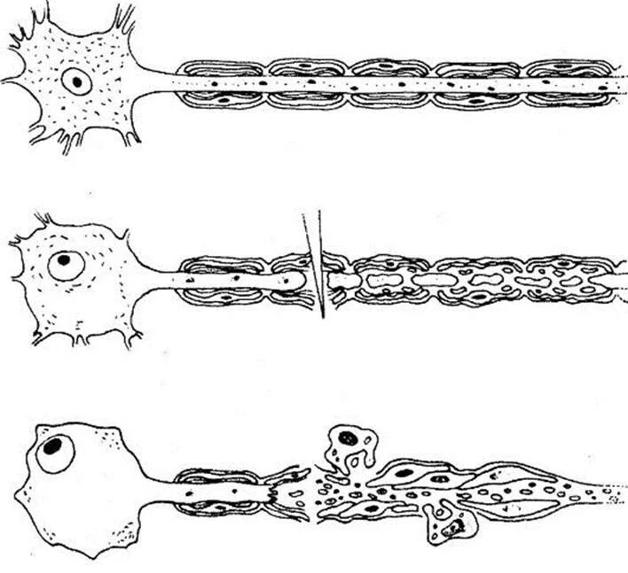 Валлеровская дегенерация нерва. Дегенерация периферического нервного волокна.. Дегенерация периферического нерва. Валлеровская дегенерация аксонов.