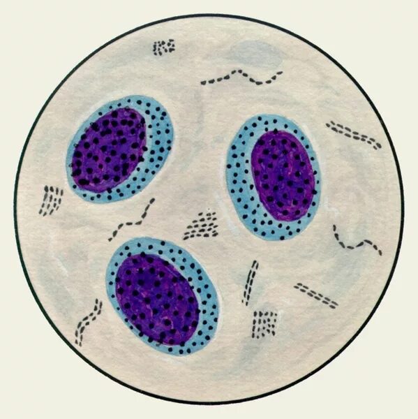 Альвеолярные макрофаги в мокроте. Альвеолярные макрофаги в мокроте микроскопия. Альвеолярные клетки в мокроте нативный препарат. Эозинофилы в мокроте микроскопия.