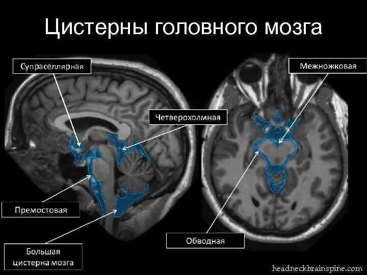 Расширенные ликворные пространства. Цистерны головного мозга на мрт. Цистерна Меккеля головной мозг. Цистерны основания головного мозга анатомия. Цистерны основания головного мозга на кт.