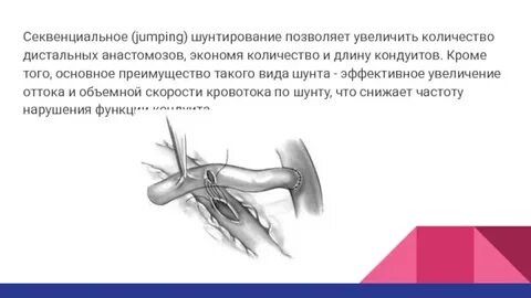 Шунтирование это простыми словами