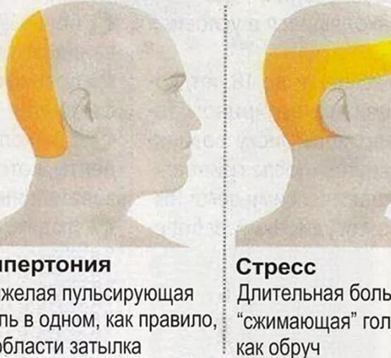 Может ли болеть голова от недосыпа. Голова болит сзади затылка. головная боль сзади головы слева. причины боли внизу головы сзади. головные боли сзади затылочной части.