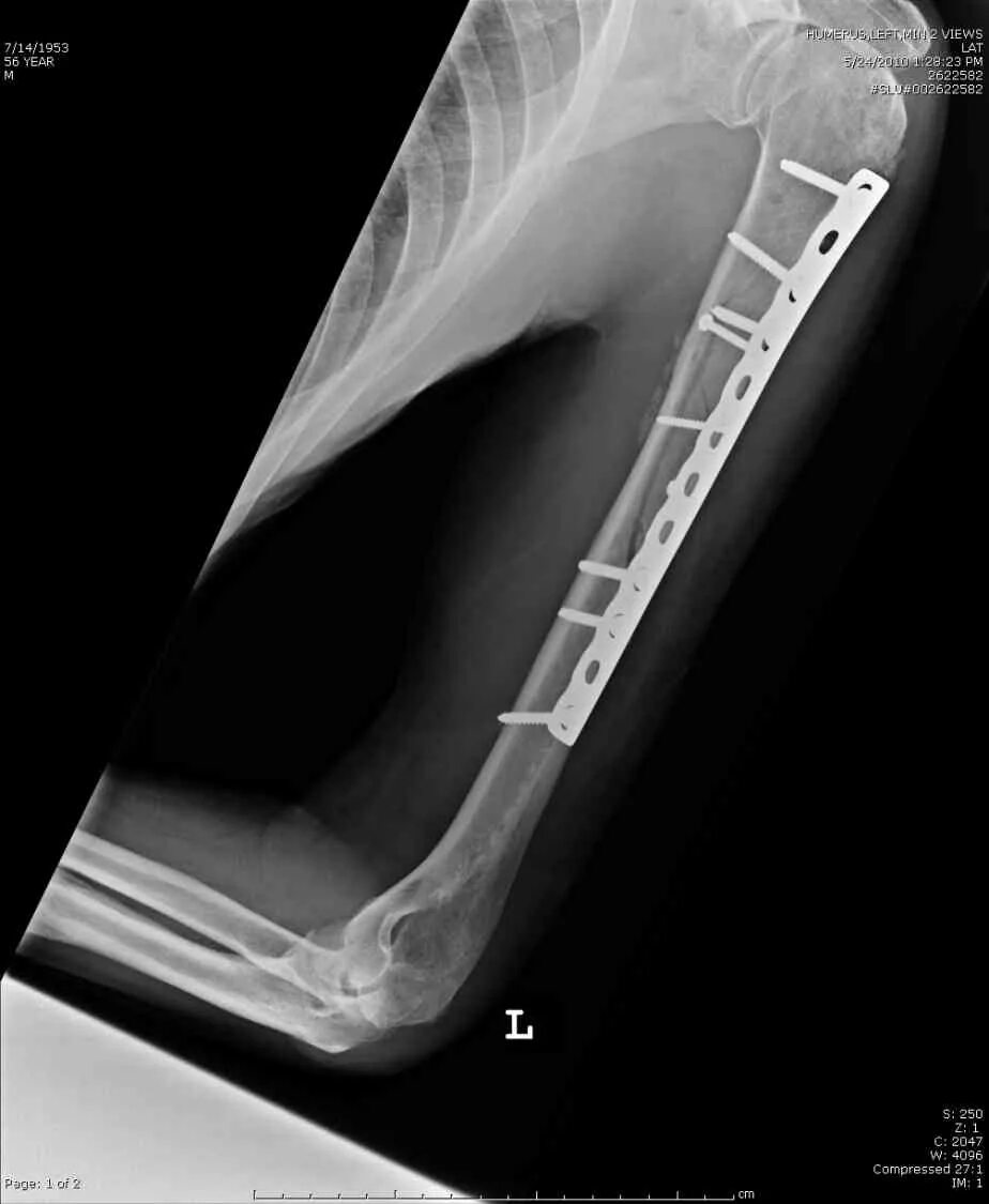 Перелом бугра плечевой кости остеосинтез. Остеосинтез пластиной перелома хирургической шейки плечевой кости. Перелом диафиза плечевой кости рентген. Мос плечевой кости. Экстрамедуллярный остеосинтез плечевой кости.