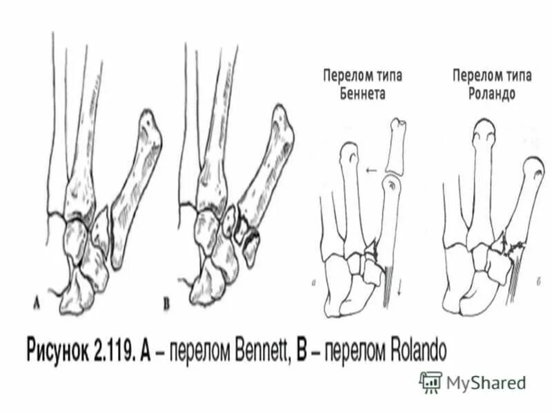 Тест по теме перелом