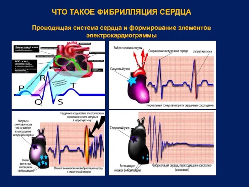 Фибрилляция форум. Фибрилляция сердца. фибрилляция сосудов сердца. проводящая система сердца экг. что вызывает фибрилляцию сердца?.
