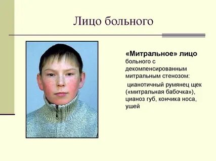 Синдром воротничка