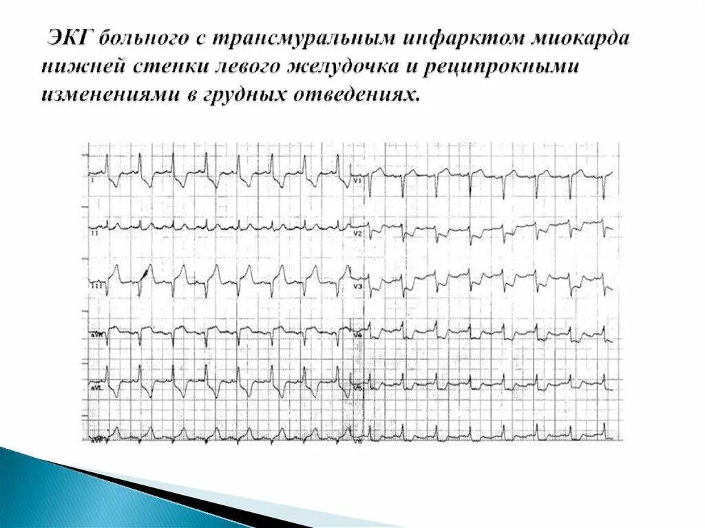 Изменения в нижней стенке левого желудочка. Острый трансмуральный инфаркт миокарда ЭКГ. ЭКГ при трансмуральном инфаркте нижней стенки. Трансмуральный инфаркт миокарда задней стенки. Трансмуральный инфаркт миокарда на ЭКГ.