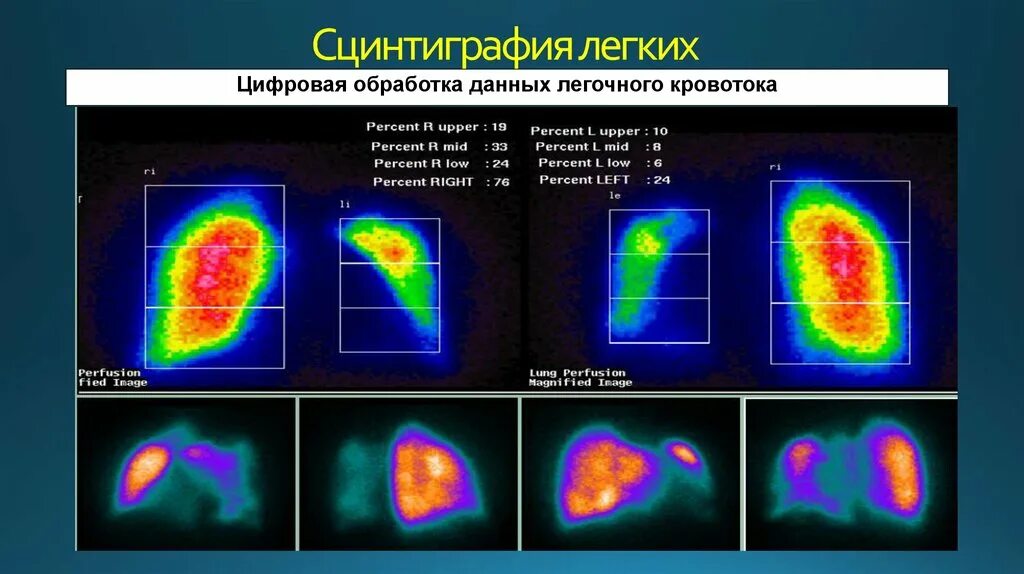 Исследование изотопами. Перфузионная сцинтиграфия легких норма. Радиоизотопное исследование (сцинтиграфия почек. Сцинтиграфия почек холодный очаг. Сцинтиграфия щитовидной железы аппарат.