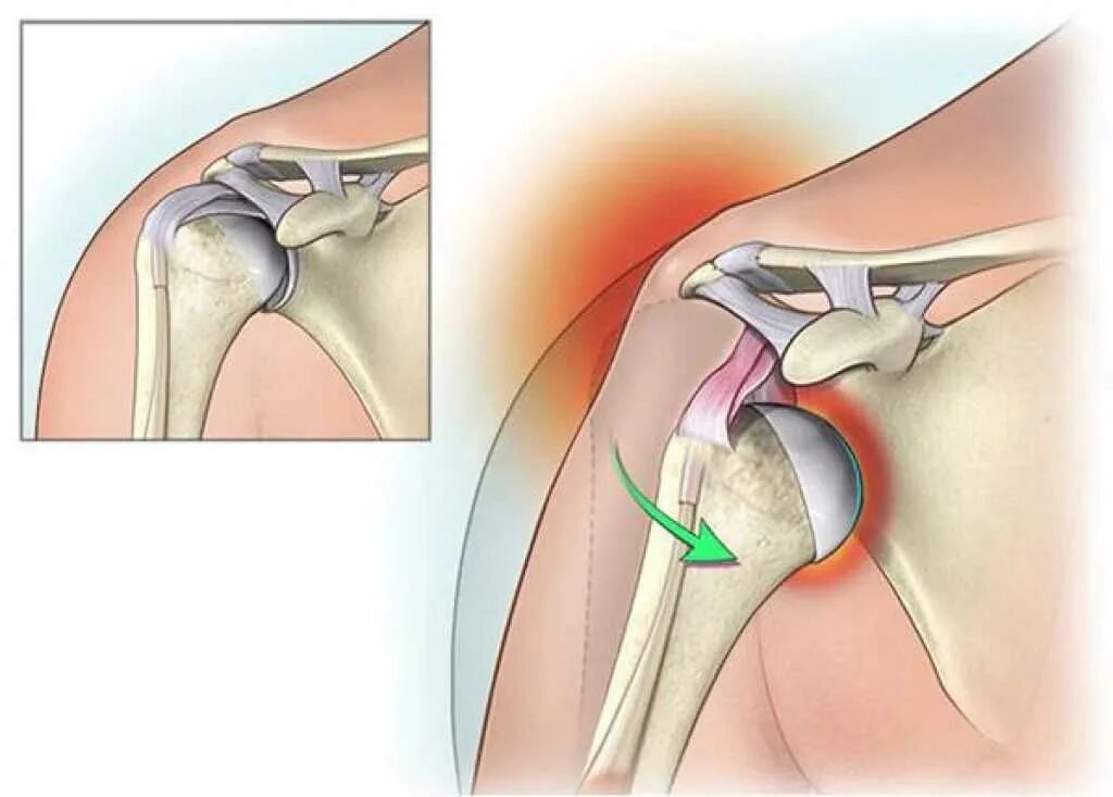 Нижний вывих плечевого сустава. Плечелопаточный сустав,вывих. Привычный вывих плечевого сустава рентген. Привычный подвывих плечевого сустава. Стучит плечо