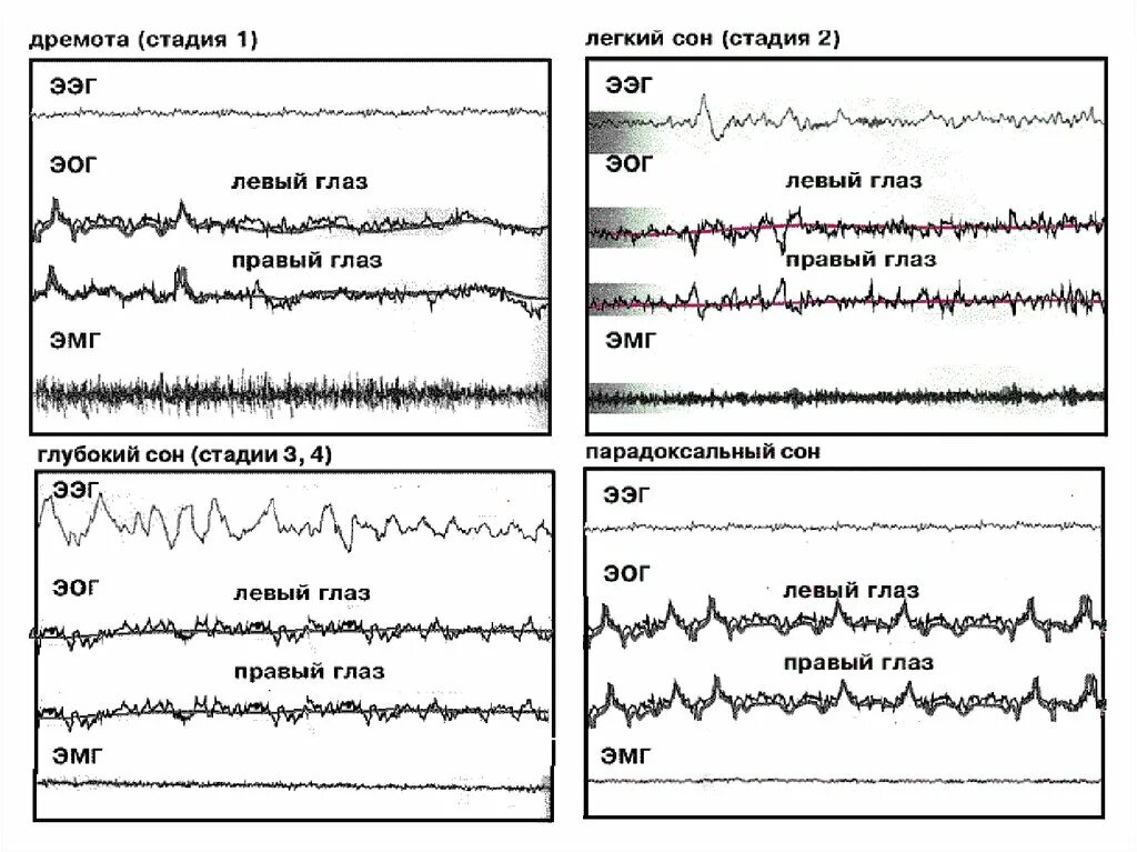 Срок ээг. Фаза быстрого сна ЭЭГ. 2 Стадия сна на ЭЭГ. Фаза засыпания на ЭЭГ. Фазы сна показатели ЭЭГ.