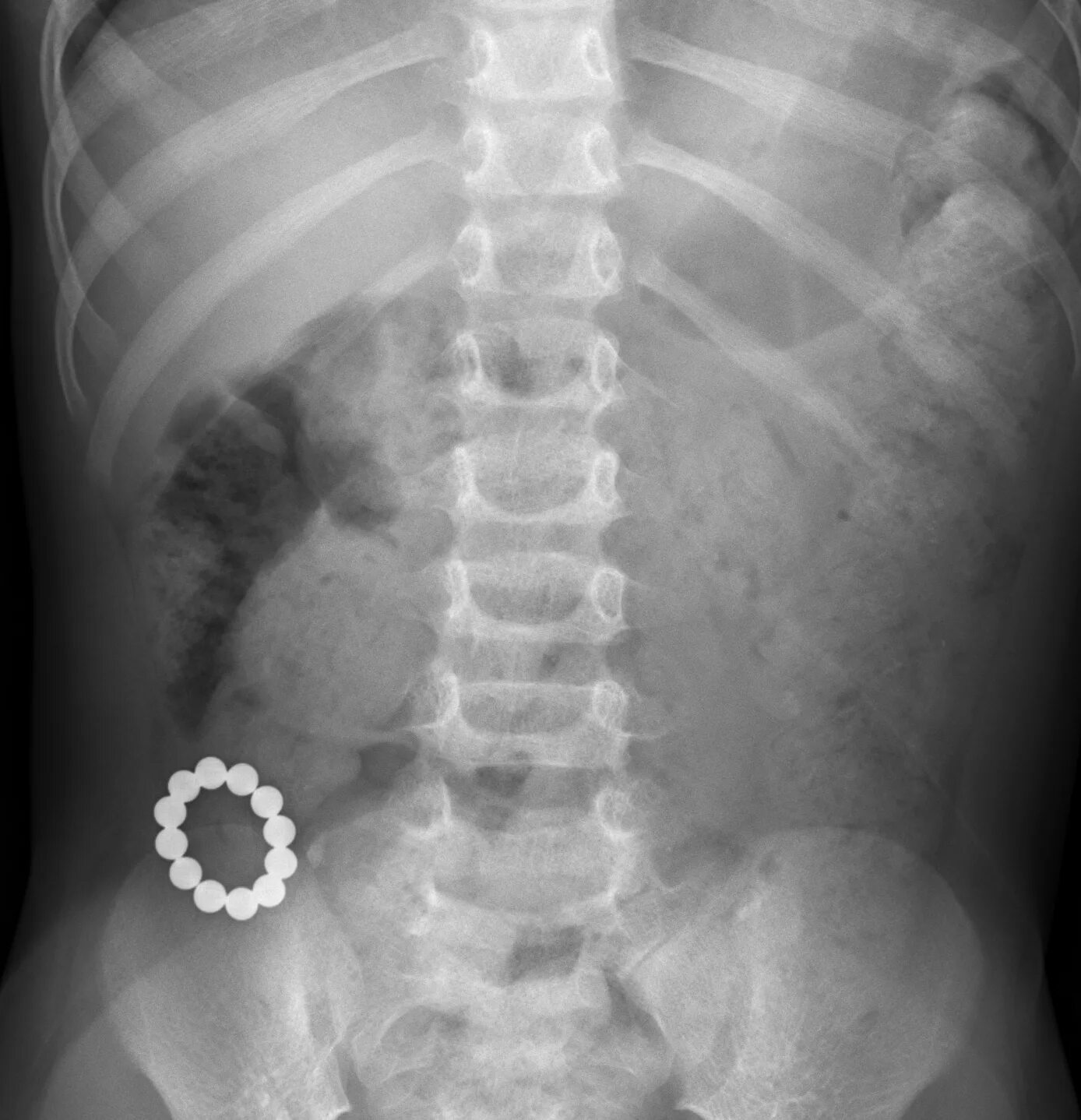 Проглотил большим куском. Обзорная рентгенограмма брюшной полости. Рентген брюшной полости норма. Обзорная рентгенограмма брюшной полости норма. Рентген брюшной полости инородное тело.