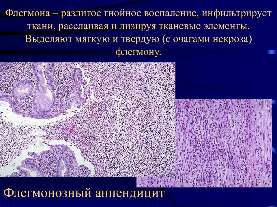 Аппендицит патанатомия. Флегмонозный аппендицит патологическая анатомия. Флегмона кожи патанатомия. Флегмона подкожной клетчатки патанатомия. Флегмонамягуких тканей препарат.