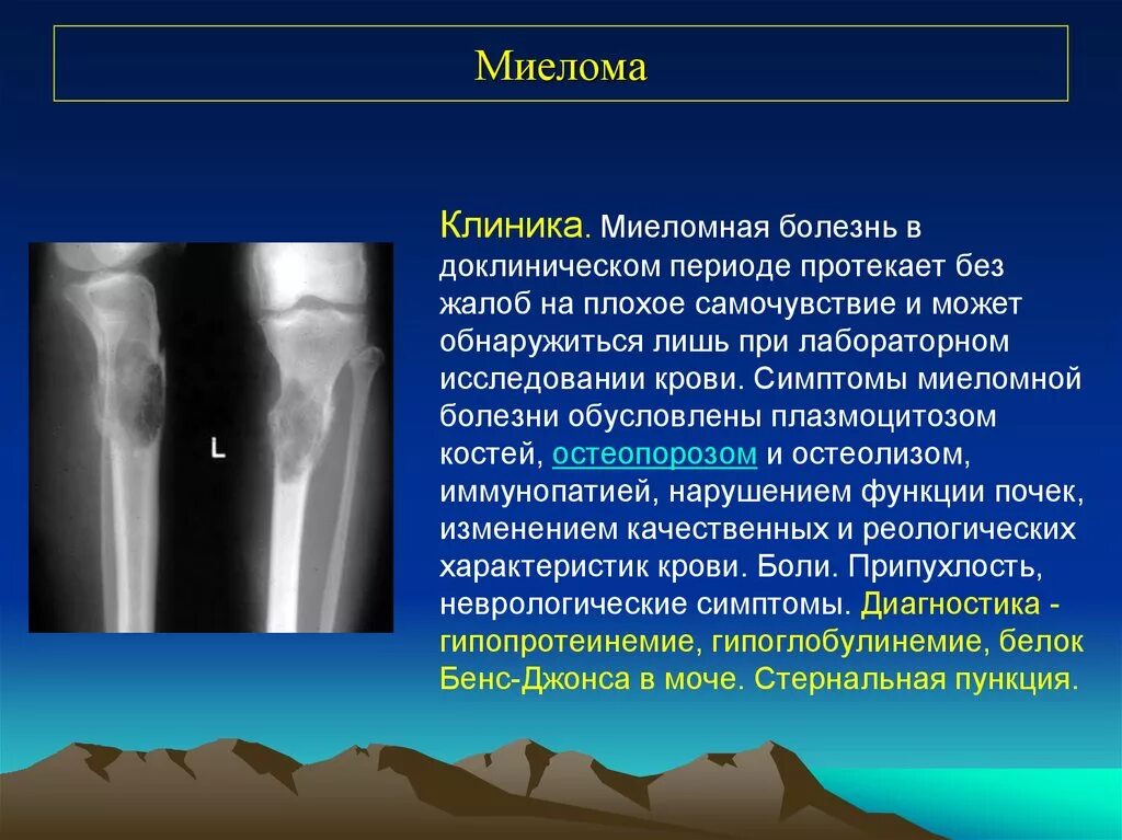 Рак в костях прогноз. Опухоль поражения кости. Миеломная болезнь костного мозга симптомы. Опухоли костей презентация. Опухоли костей симптомы.