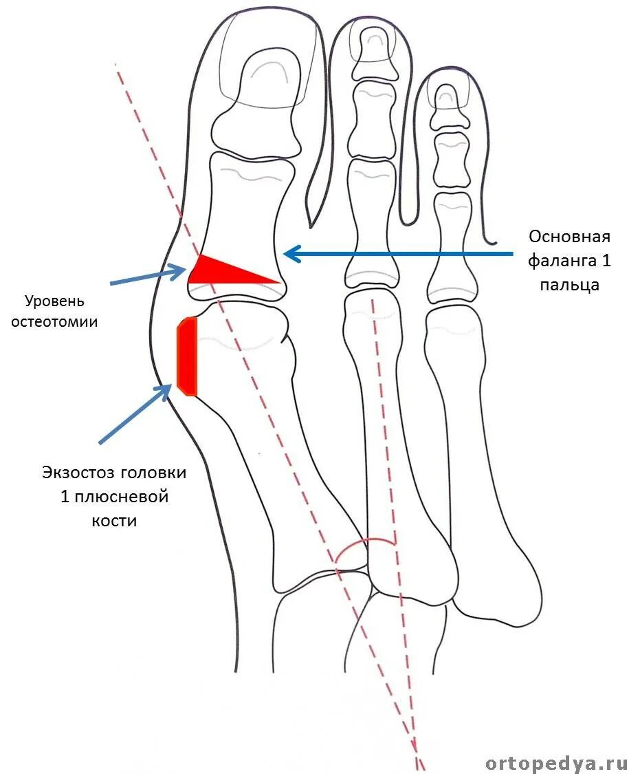 Фаланги стопы. Экзостоз головки 1 плюсневой. Экзостоз головки 1 плюсневой кости. Экзостоз головки плюснев йкости. Экзостоз 5 плюсневой кости.