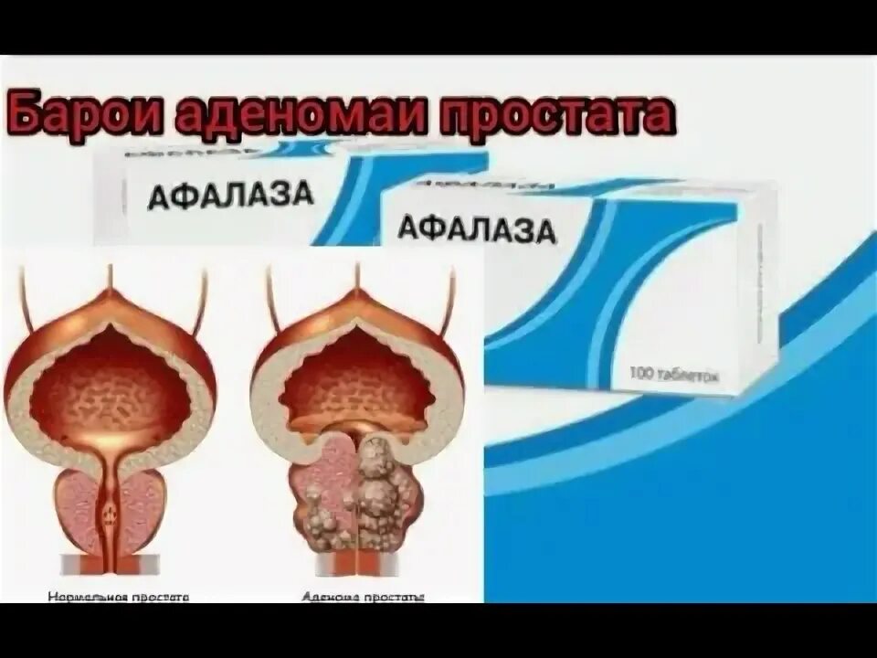 Афалаза при простатите