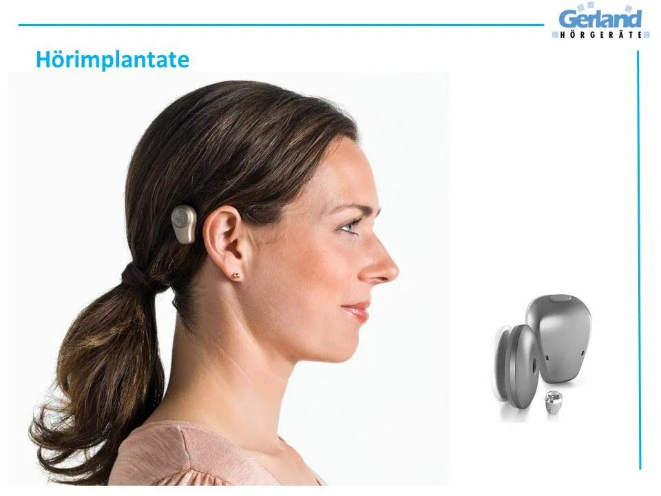 ADHEAR слуховой аппарат. Слуховой аппарат Baha. Слуховой аппарат с костной проводимостью ADHEAR. Неимплантируемый слуховой аппарат Baha. Hear system