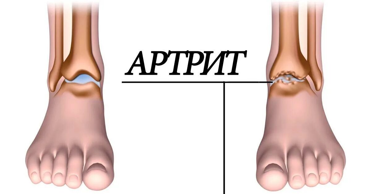 Артрит это. Ревматоидный артрит ступни. Асимметричный олигоартрит.