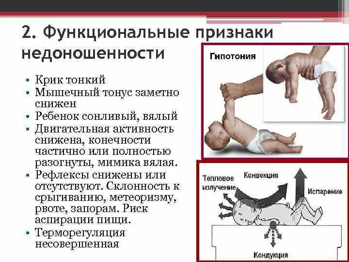 Функциональные признаки недоношенности ребенка. Функциональные признаки недоношенного. Тонус мышц. Гипертонус мышц.