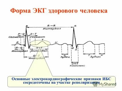 Форма экг
