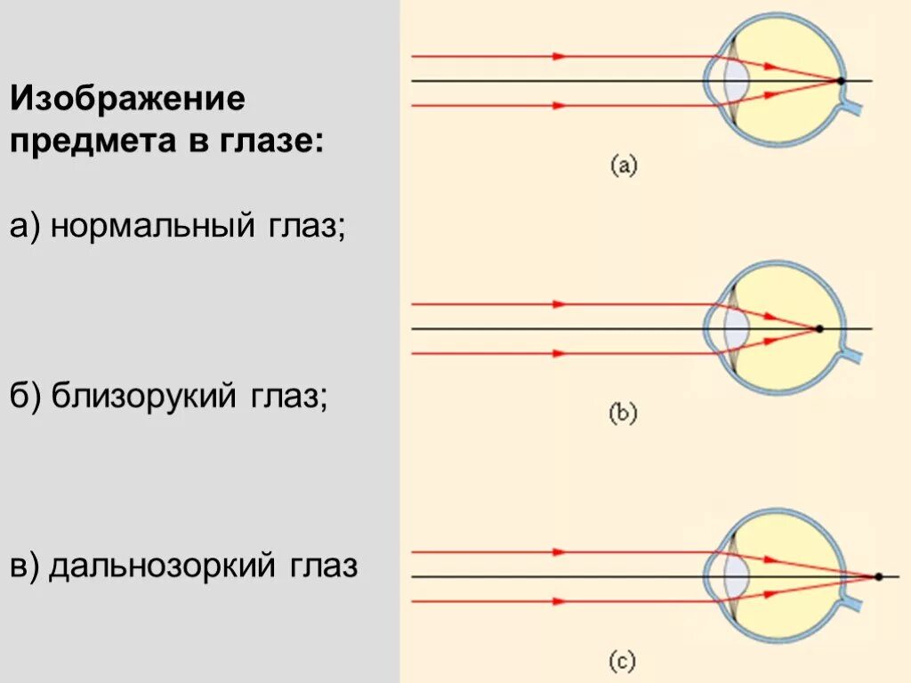 Глаз и зрение физика 9. Дефекты зрения физика оптика. Нормальный близорукий дальнозоркий глаз. Схема коррекции близорукости и дальнозоркости. Начертите изображение предмета для дальнозоркого глаза.