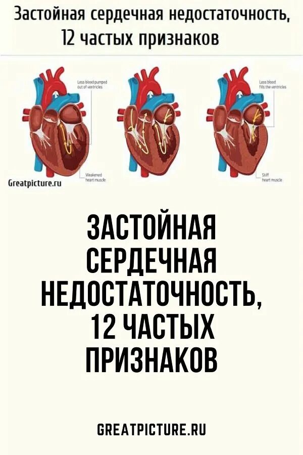 Что значит застойная сердечная недостаточность. Сердечная недостаточность. Сердечная недостаточно. Застойная сердечная недостаточность. Симптомы сердечной недостаточности.