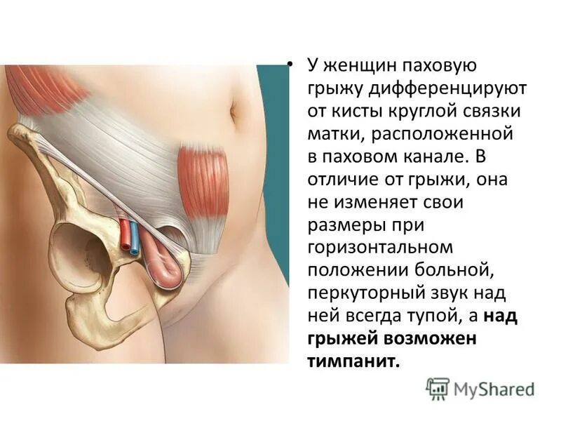 Паховая связка и паховая грыжа. Паховый канал круглая связка матки. Круглая маточная связка. Где находятся круглые связки