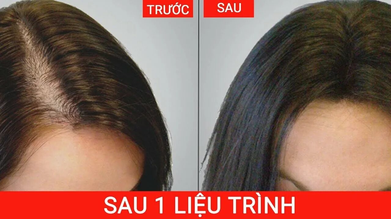 5 Superfoods To Prevent Hair Loss HealthCare. - YouTube