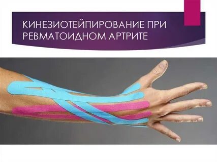 Тейпирование при артрите
