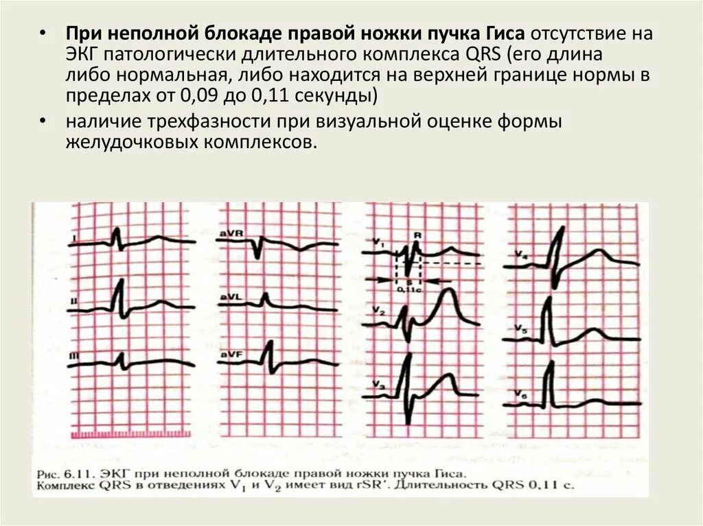 Блокада ножки гиса симптомы. ЭКГ при неполной блокаде правой ножки пучка Гиса. Полная блокада левой ветви пучка Гиса на ЭКГ. Неполная блокада левой ножки пучка Гиса на ЭКГ. ЭКГ блокада левой ножки пучка Гиса ЭКГ.