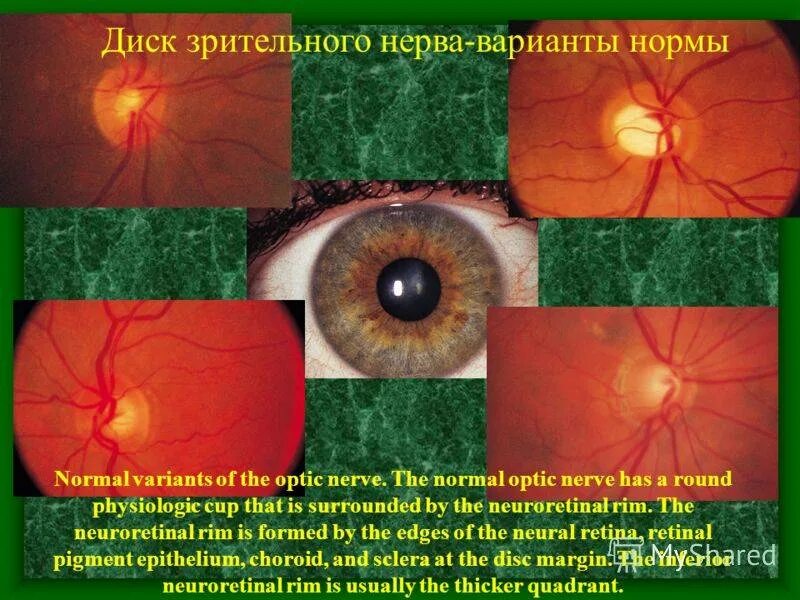 Норма зрительного нерва. Экскавация диска зрительного нерва окт. Опухоли зрительного нерва глазное дно.