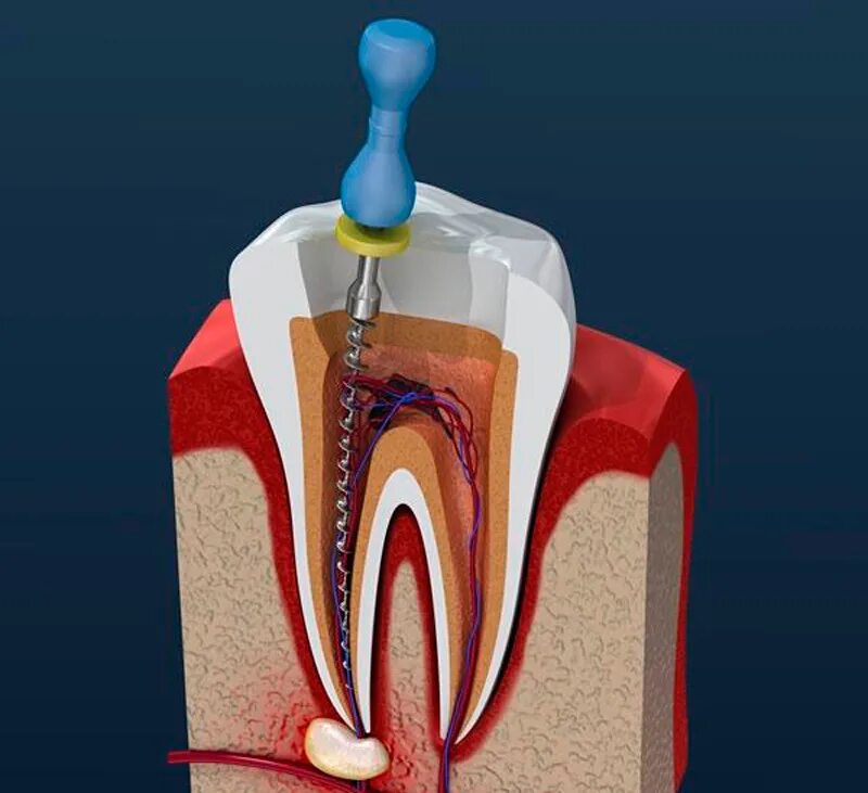 Как удаляют нерв в зубе